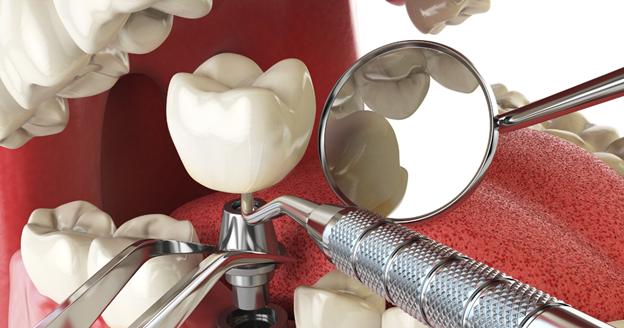 are dental implants covered by insurance