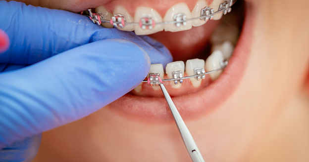 image-8 6 Easy Ways to Care For Your Braces